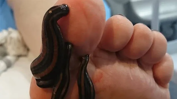 leech-treatment