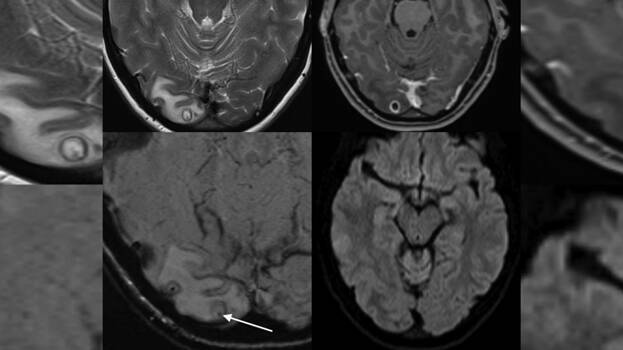 tapeworm-larvae tapeworm-larvae
