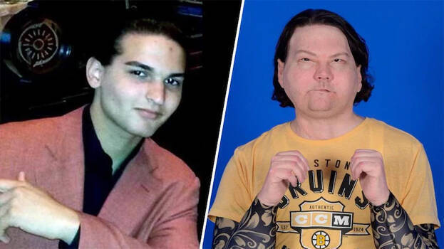 face-hand-transplant face-hand-transplant