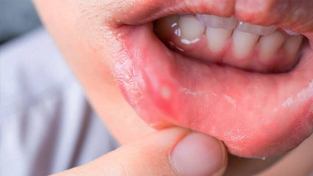 mouth-sore mouth-sore