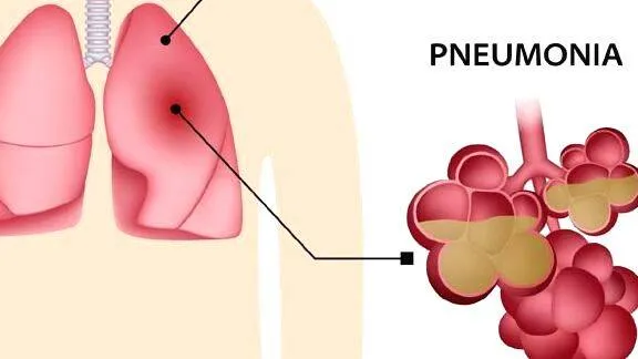 pnumonia