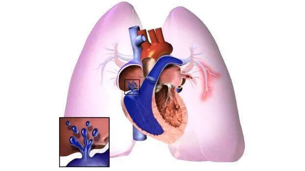 pulmonary-hypertension
