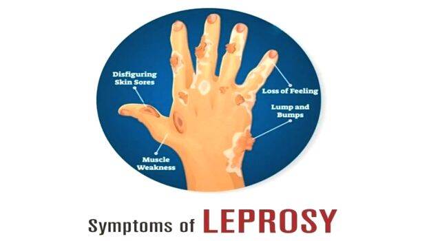 leprosy