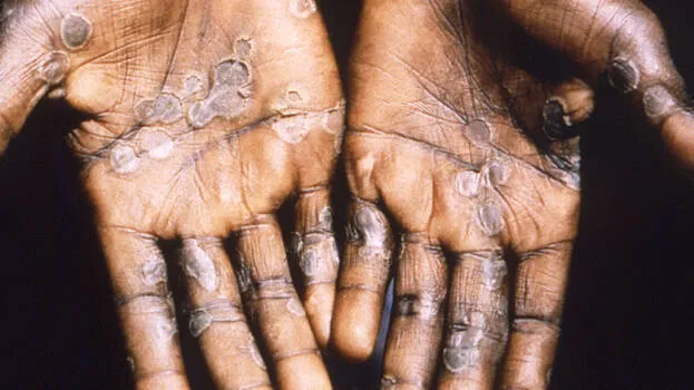 monkeypox-