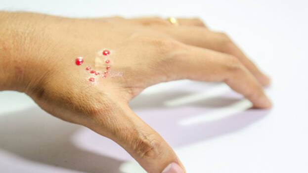 snake-bite- snake-bite-