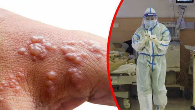 monkey-pox monkey-pox