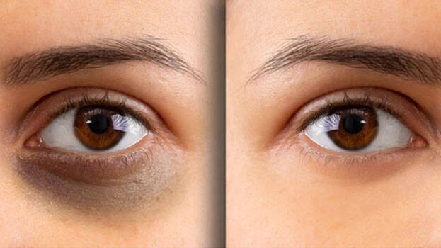 dark-circles dark-circles