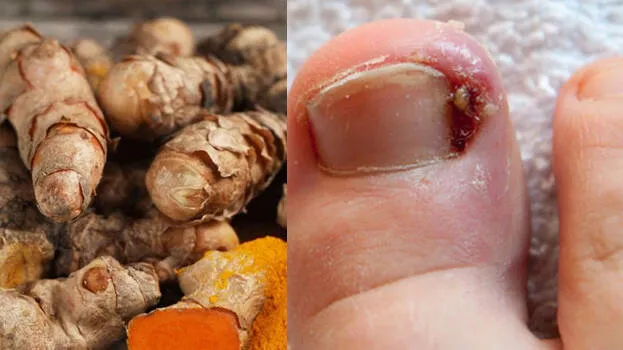 turmeric
