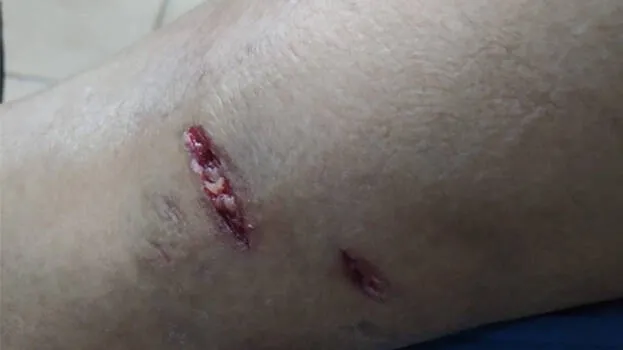 dog-bite