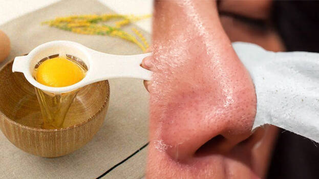 black-heads black-heads