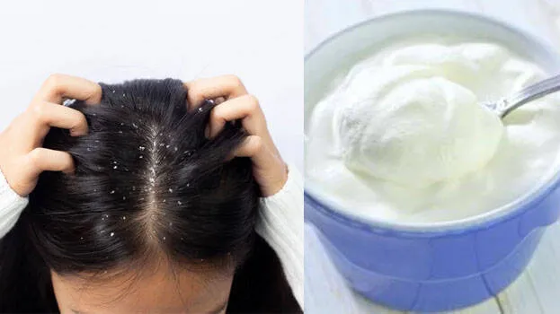 dandruff