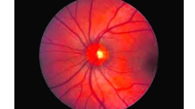 glicoma