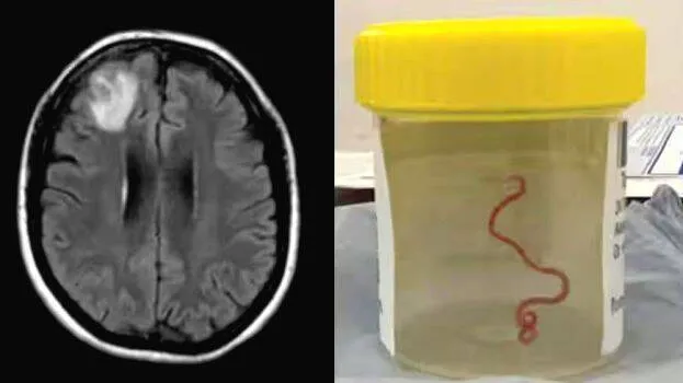 brain