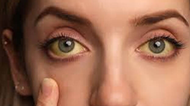 yellow-fever yellow-fever