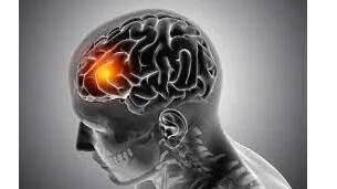 alzheimer-