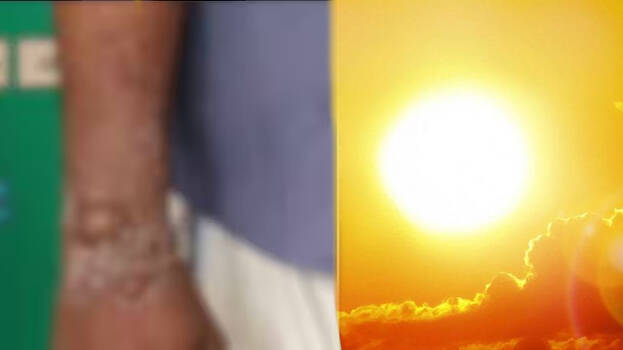 sun-burn-heat-summer-