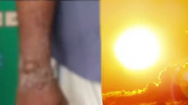sun-burn-heat-summer-