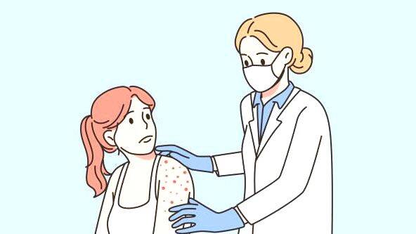 chickenpox