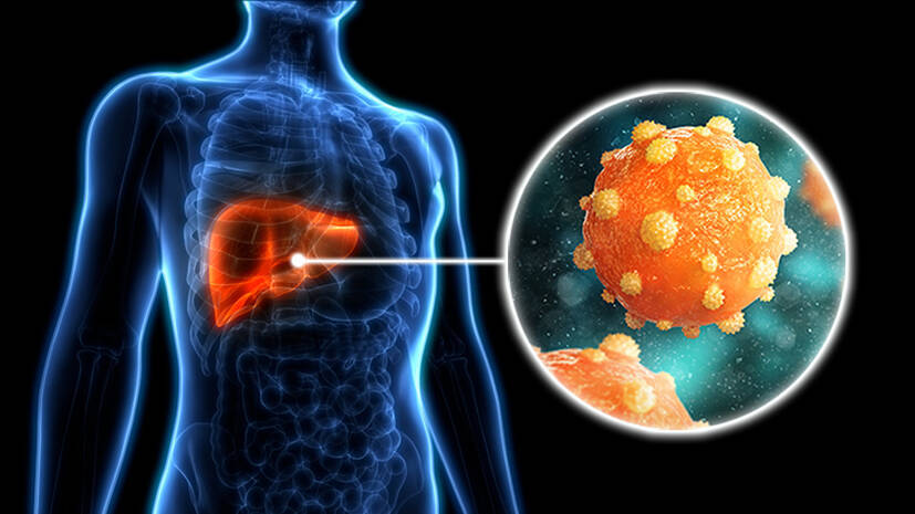 hepatitis