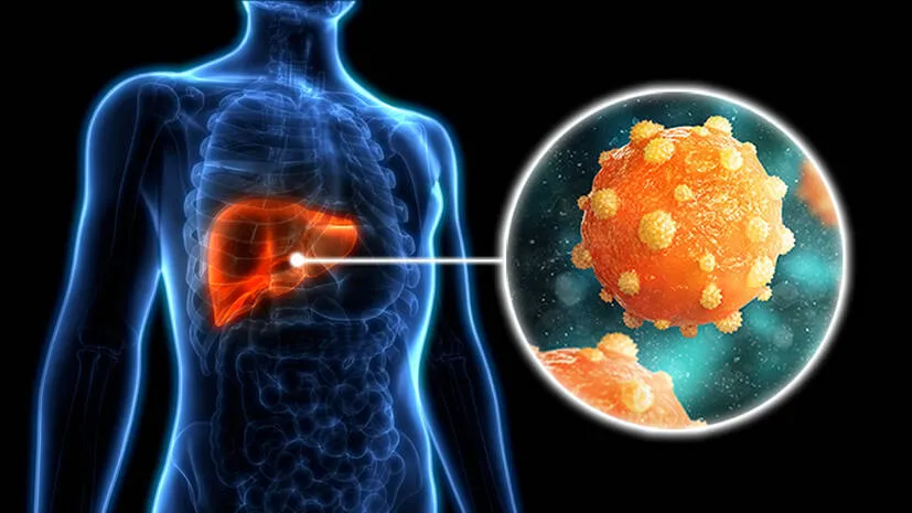 hepatitis