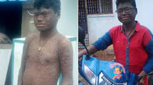 this-boy-with-mysterious-snake-skin-condition-needs-to-bathe-every-hour-for-relief