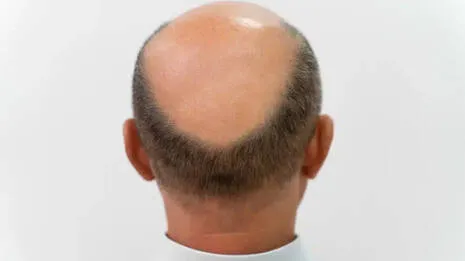 baldness