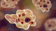 amoebic-meningoencephalitis-test-positive