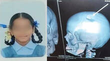 student-skull-fracture-after-teacher-hit-with-lunch-box-bag-in-andhra-pradesh