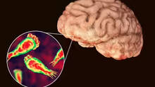 amebic-meningoencephalitis