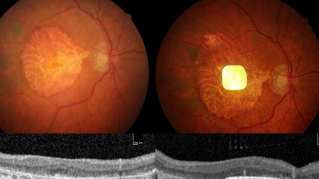 blindness blindness