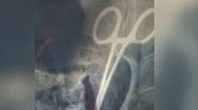 scissors-found-inside-womans-stomach-which-was-there-for-five-years