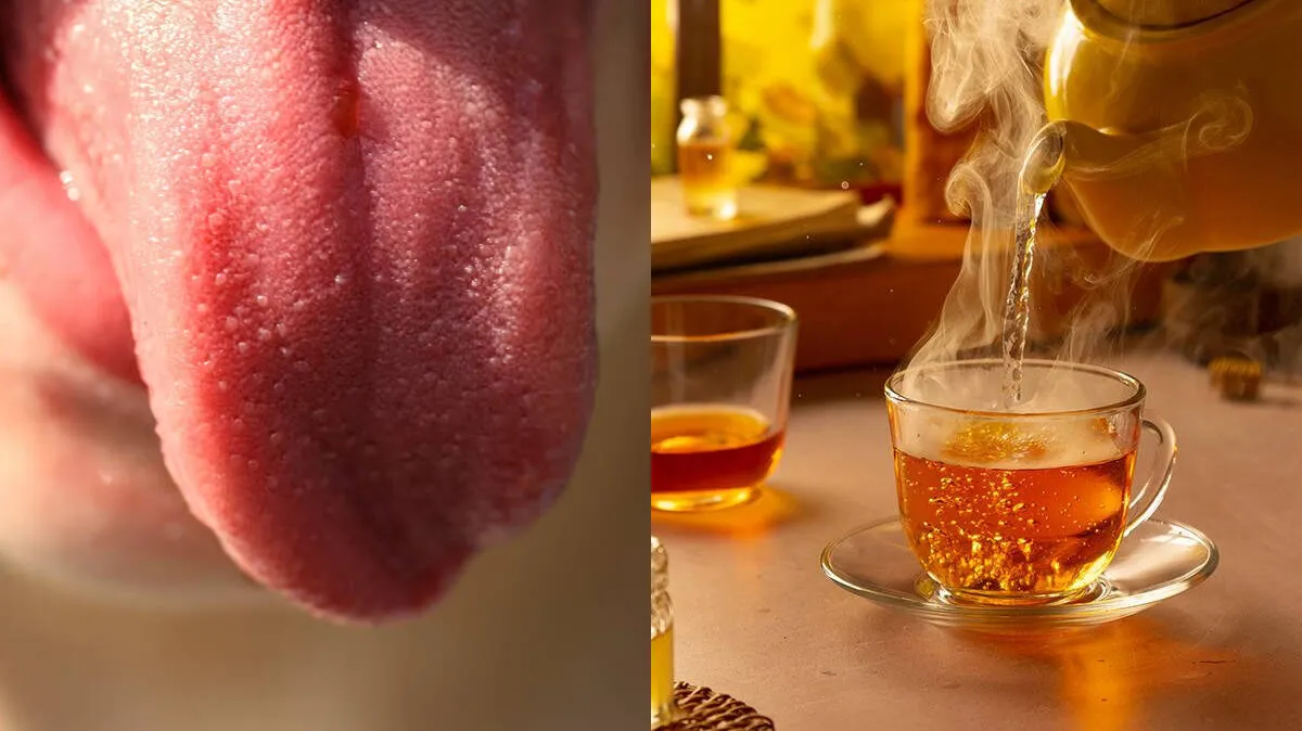 tongue-burnt