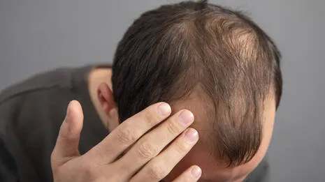 hair-loss.1.3962315
