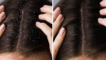 dandruff-