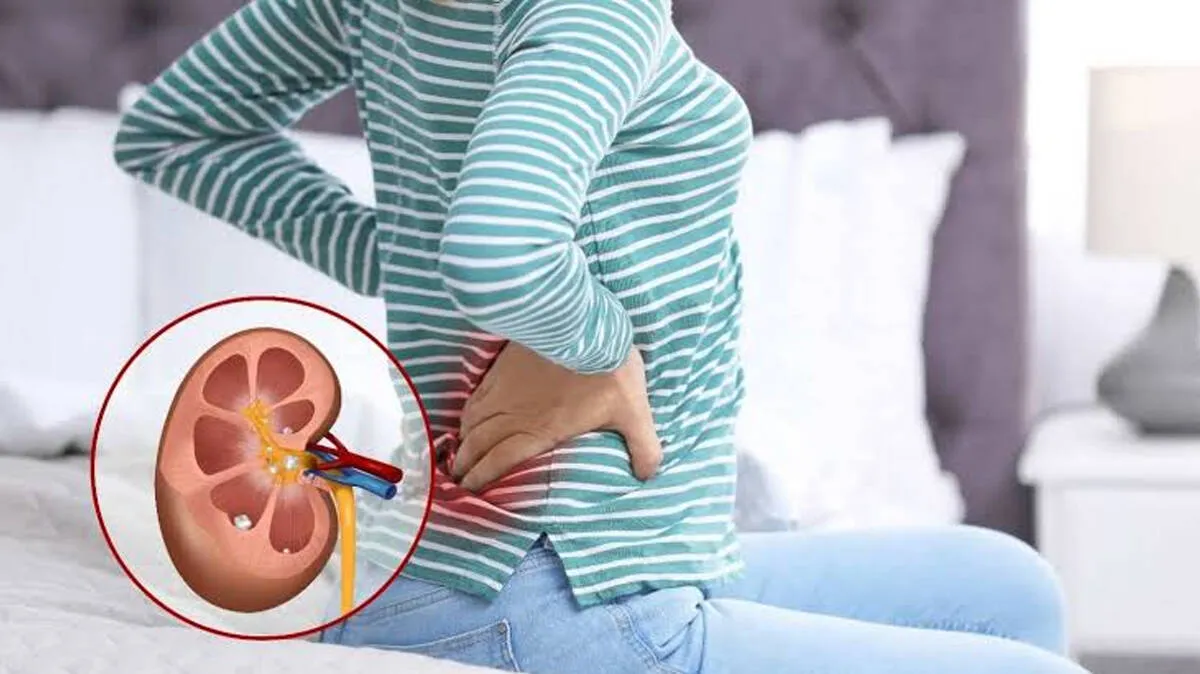 kidney-stone