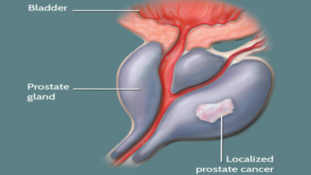 Is prostate cancer a pre existing condition Is prostate cancer a pre existing condition