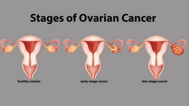 Ovarian cancer kill you. Ovarian cancer how fast does it grow