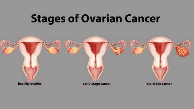 ovarian-cancer