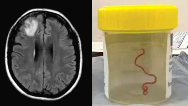 Live Python worm found in Australian woman's brain - WORLD - OTHERS ...