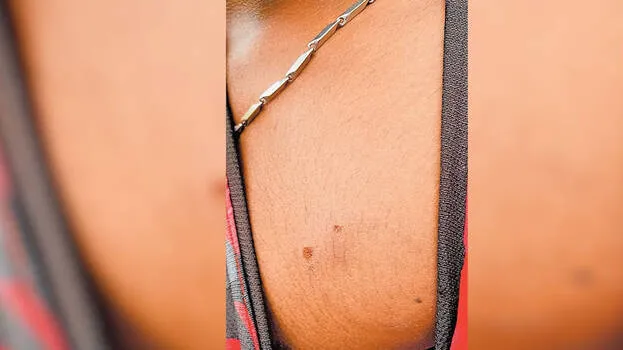 bite-marks