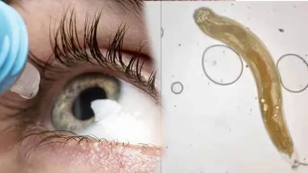 eye-worm