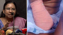 amputation-