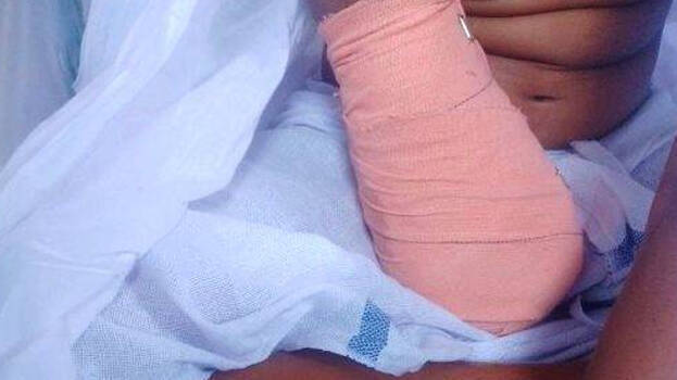 -hand-amputated